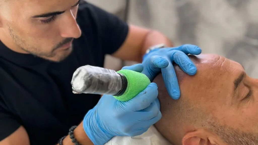 Micropigmentación Capilar Almería - Esteticista en Almería